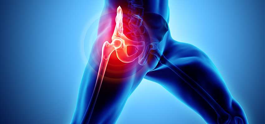 Como tratar a artrose (ou osteoartrose ou coxartrose) de quadril? - Dr.  Tácito A. Okuma | Ortopedia | Traumatologia | Cirurgia do Quadril