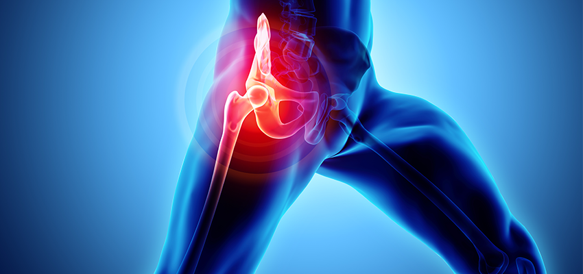 Como tratar a artrose (ou osteoartrose ou coxartrose) de quadril?