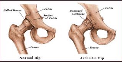 O que é artrose, osteoartrose de quadril ou coxartrose?
